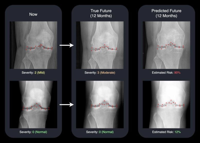 AI Predicts Osteoarthritis Progression